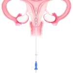 Embryotransfer a inseminace