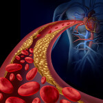 Kardiovaskulární onemocnění